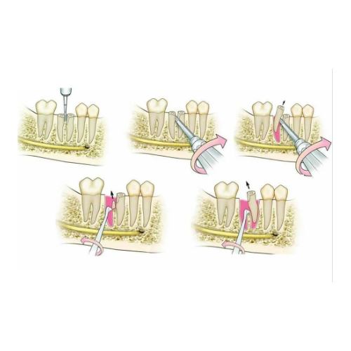 GDC Root Elevator Set Of 9 In Pouch (RESP9) 05